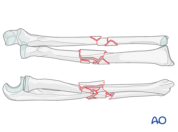 Multifragmentary, fragmentary segmental fracture of both bones