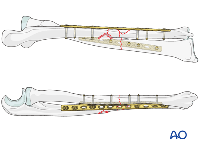 ORIF - Plating of one or both bones for Multifragmentary ulnar fracture ...