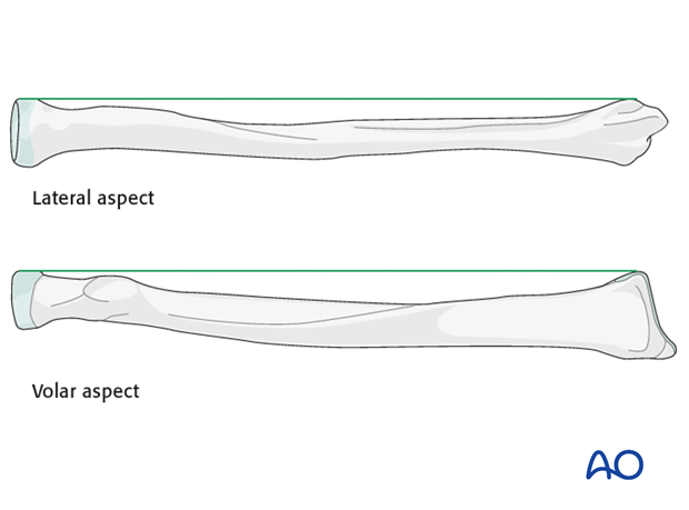 orif bridge plating