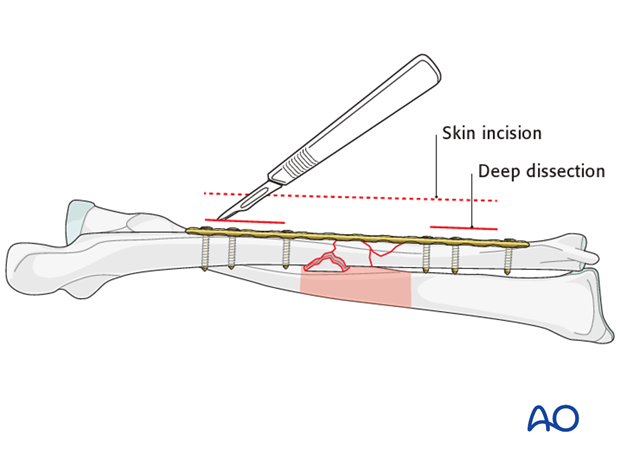 Extent of surgical approach (dissection)