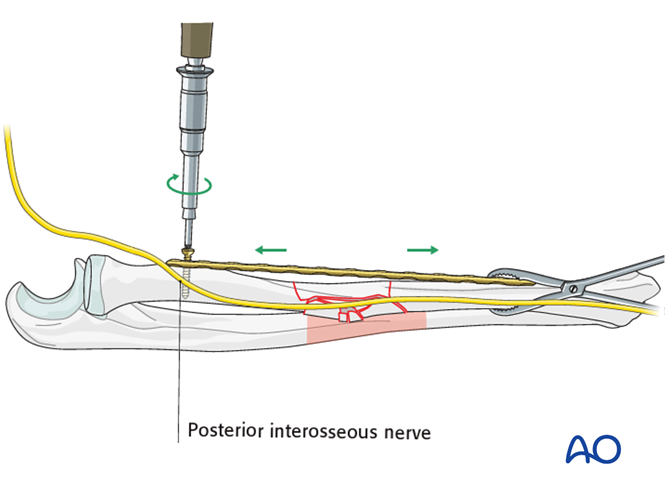 Comminuted radial fracture: bridge plating