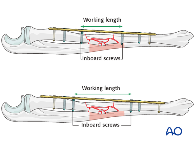 Working length considerations