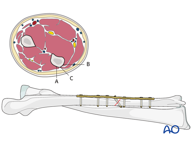 Oref Leg ORIF - Lag screw and plate fixation for Oblique simple fracture of the ulna