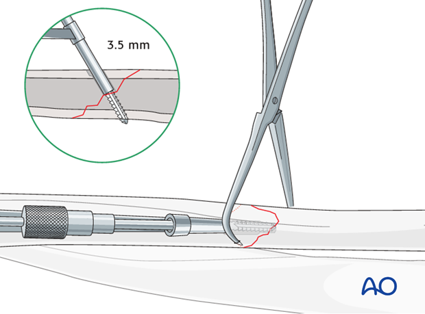 Fixation – lag screw as primary fixation device separate from plate