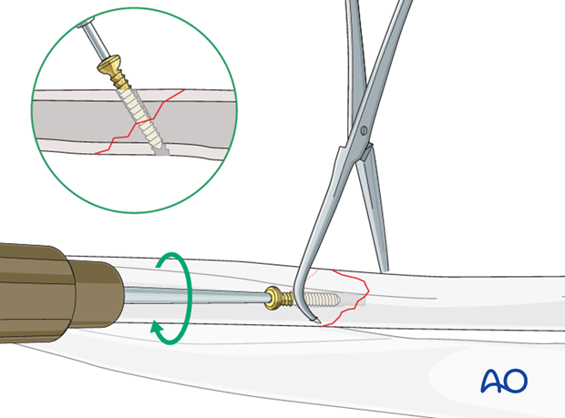 Fixation – lag screw as primary fixation device separate from plate