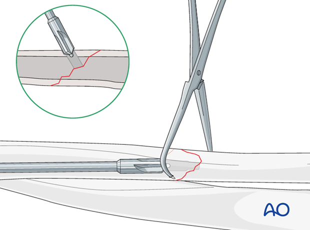 Fixation – lag screw as primary fixation device separate from plate