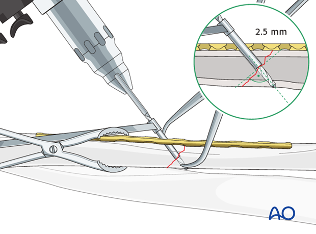 Fixation – lag screw as primary fixation device through the plate