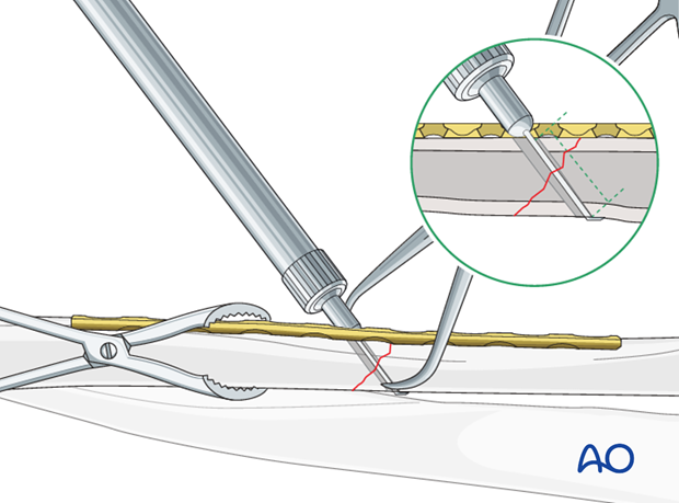 Fixation – lag screw as primary fixation device through the plate