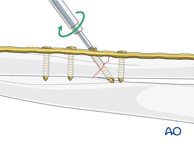 Fixation – compression plating with an additional lag screw