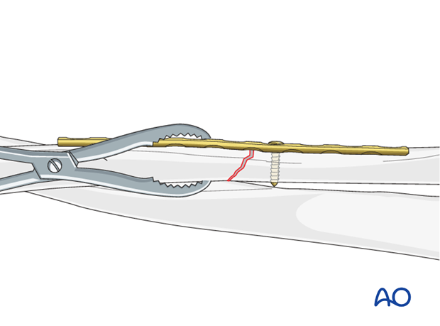 Fixation – compression plating with an additional lag screw