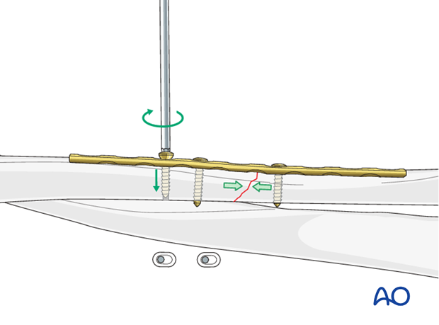 Fixation – compression plating with an additional lag screw