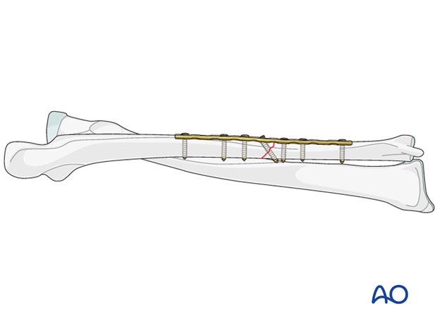 Fixation – compression plating with an additional lag screw