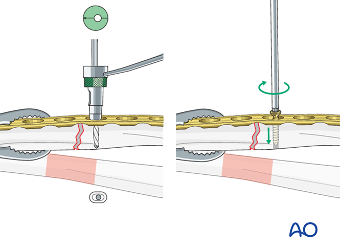 Transverse radial fracture: compression plating