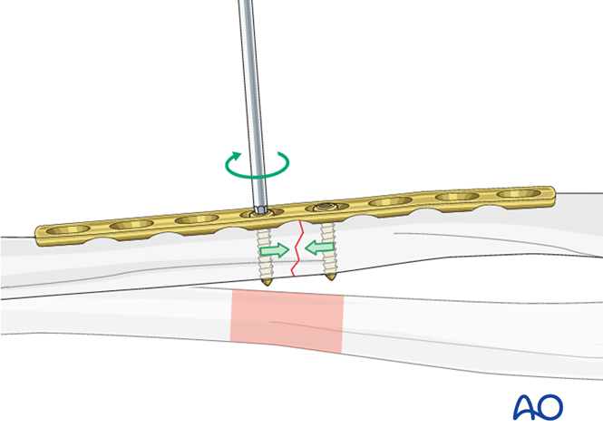 Transverse radial fracture: compression plating