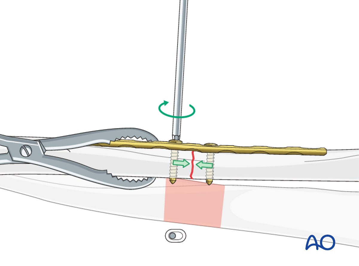 Transverse Ulnar Fracture: Compression Plating