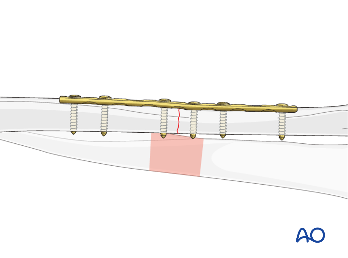 Transverse Ulnar Fracture: Compression Plating