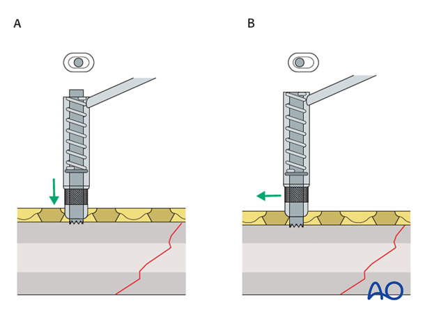 Fixation – compression plating with an additional lag screw