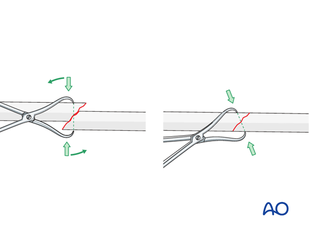 lengthening by twisting of reduction forceps