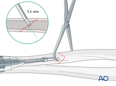 Oref Leg ORIF - Lag screw and plate fixation for Oblique simple fracture of the ...