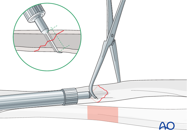 Fixation – lag screw as primary fixation device separate from plate