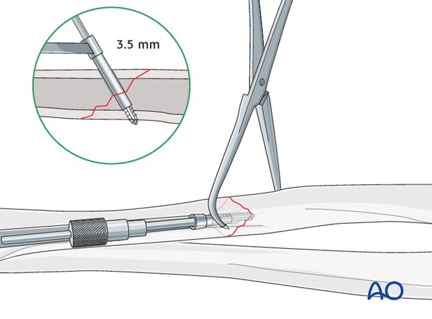 Fixation – lag screw as primary fixation device separate from plate