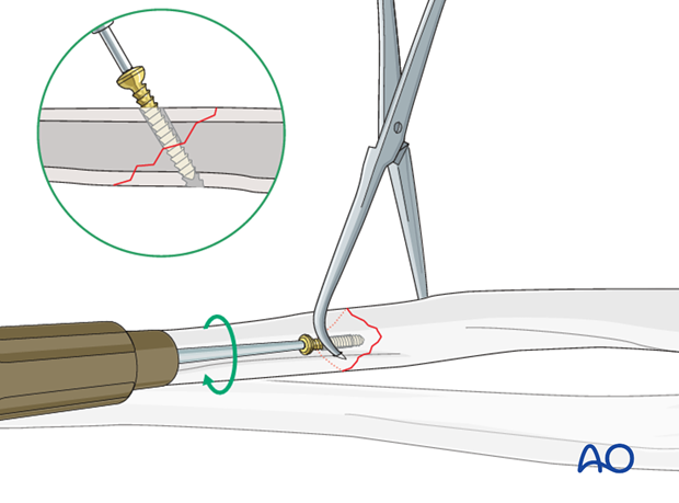 Fixation – lag screw as primary fixation device separate from plate