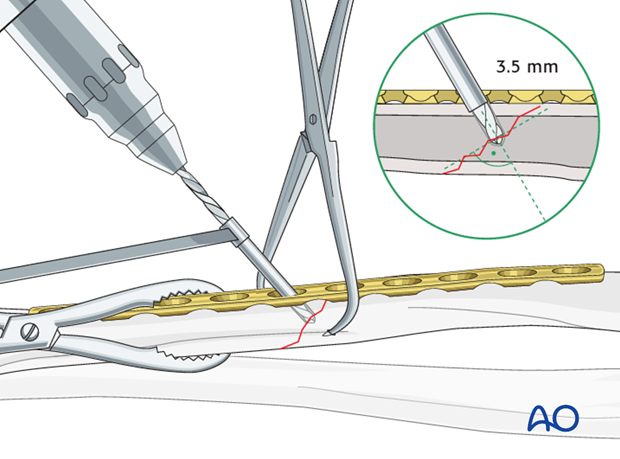 Fixation – lag screw as primary fixation device through the plate