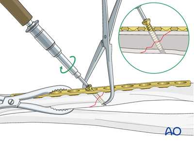Oref Leg ORIF - Lag screw and plate fixation for Oblique simple fracture of the ...