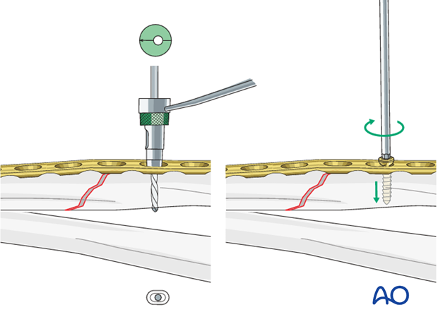 Fixation – compression plating with an additional lag screw