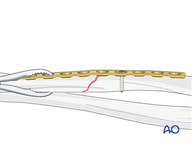 Oref Leg ORIF - Lag screw and plate fixation for Oblique simple fracture of the ...