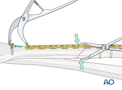 Oref Leg ORIF - Lag screw and plate fixation for Oblique simple fracture of the ...