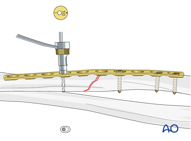 Oref Leg ORIF - Lag screw and plate fixation for Oblique simple fracture of the ...