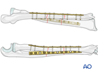 multifragmentary intact segmental fracture of both bones