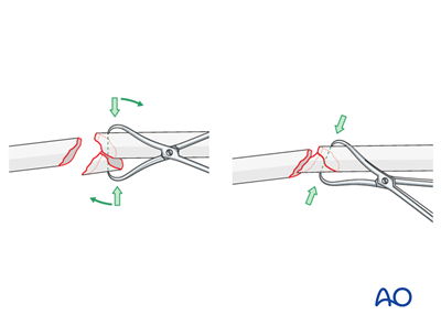 ORIF - Compression Plating for Wedge fracture of the radius with no ...