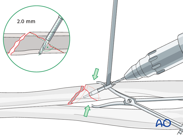 Fixation of the wedge fragment with a separate lag screw