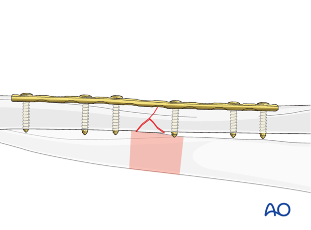 Plate position, length and number of screws