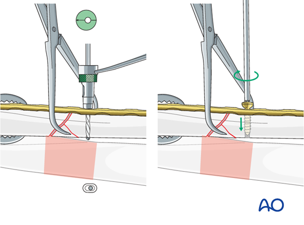 No direct fixation of the wedge fragment