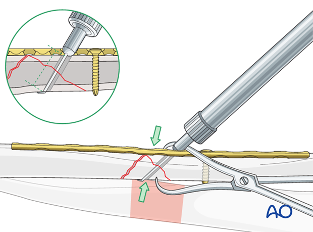 Fixation of the wedge fragment with a lag screw through the plate.