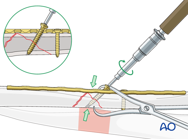 Fixation of the wedge fragment with a lag screw through the plate.