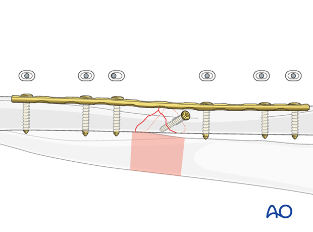 Fixation of the wedge fragment with a separate lag screw