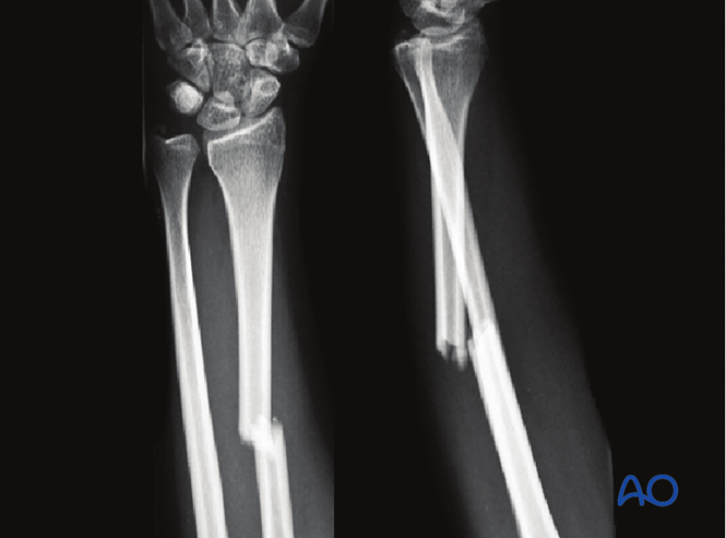 ORIF - Plating for Simple fracture of the radius, with dislocation of ...
