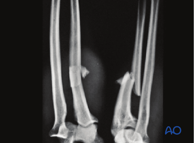 ORIF - Plating for Simple fracture of the ulna, with dislocation of ...