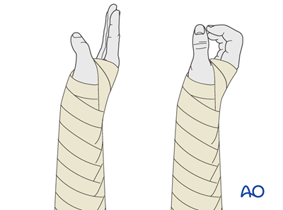 ORIF - Plating of one or both bones for Multifragmentary radial ...