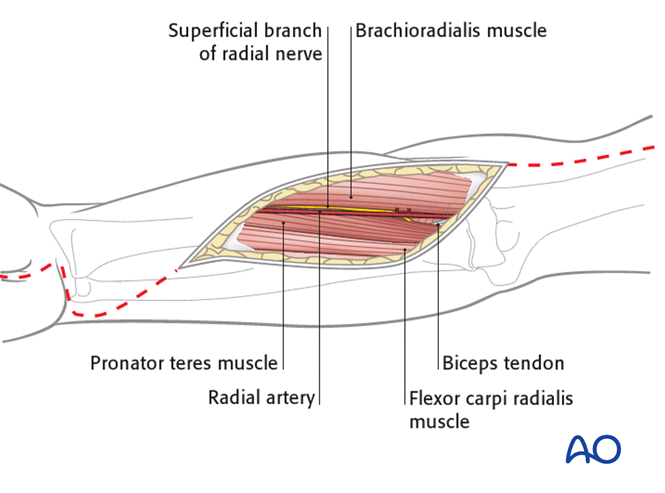 Compartment syndrome