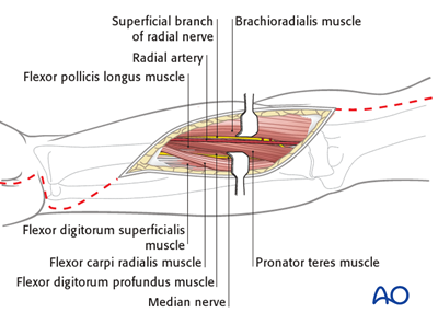 Compartment syndrome