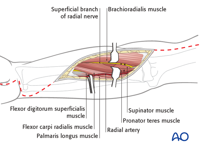 Compartment syndrome