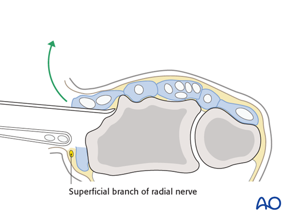 direct approach to the radial styloid