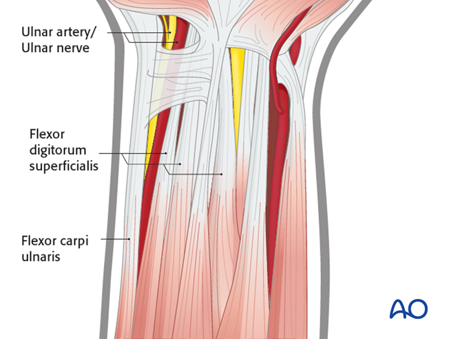 Ulnar palmar approach to the distal radius