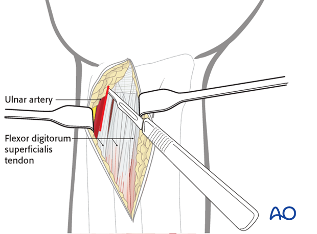 ulnar palmar approach to the distal radius