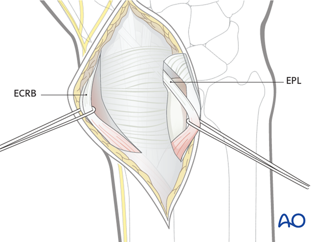 ORIF - Radial column plate for Partial articular, sagittal ...